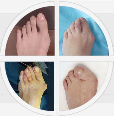 圣嘉新蘇敬達(dá):大腳骨手術(shù)微創(chuàng)的好還是傳統(tǒng)的好?怎么治療徹底?