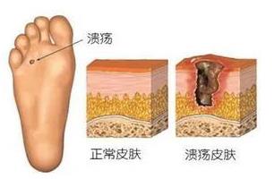 圣嘉新蘇敬達(dá):大腳骨手術(shù)微創(chuàng)的好還是傳統(tǒng)的好?怎么治療徹底?