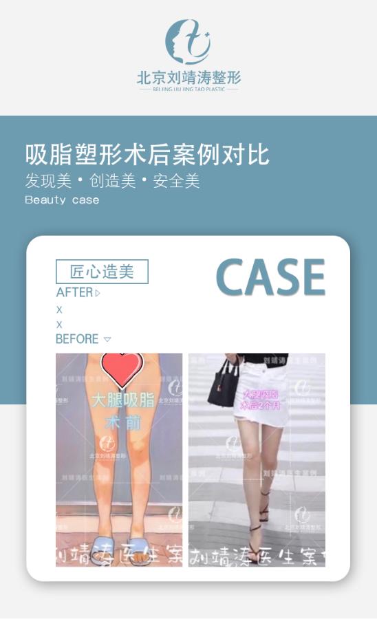 為什么很多女孩選擇北京劉靖濤整形做大小腿吸脂手術(shù)