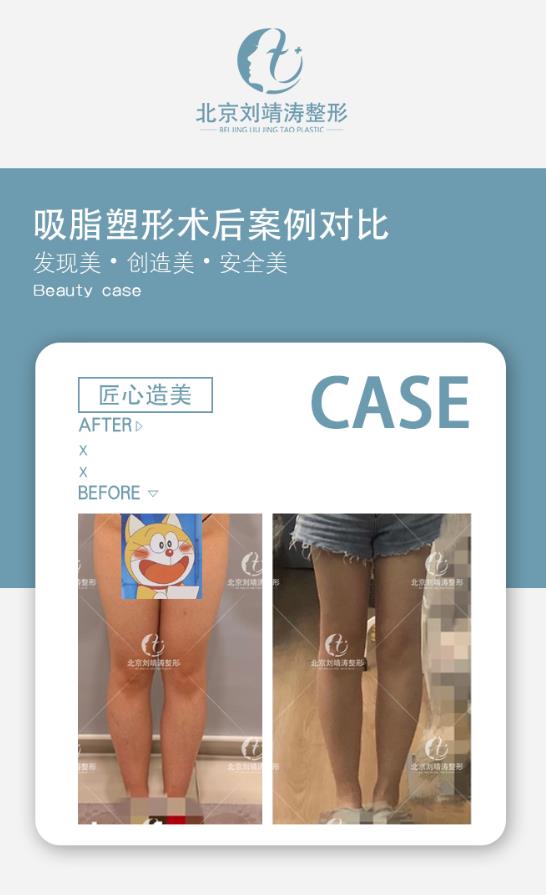 為什么很多女孩選擇北京劉靖濤整形做大小腿吸脂手術(shù)