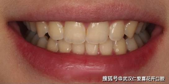 武漢仁愛口腔隱形矯正打造完美笑容,30歲“齙牙妹矯正后居然這么美!