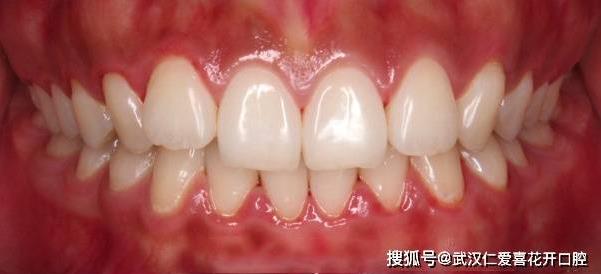 武漢仁愛口腔隱形矯正打造完美笑容,30歲“齙牙妹矯正后居然這么美!