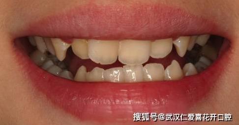 武漢仁愛口腔隱形矯正打造完美笑容,30歲“齙牙妹矯正后居然這么美!