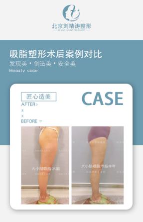 考慮做大小腿吸脂手術(shù)可以先讓醫(yī)生面診在做手術(shù)——北京吸脂醫(yī)生劉靖濤