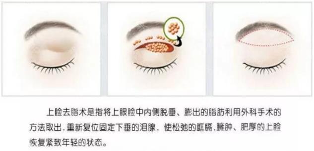 怎么設(shè)計(jì)才會好看 割雙眼皮就來南通初戀眼整形中心