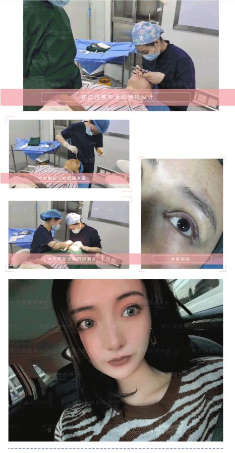 怎么設(shè)計(jì)才會好看 割雙眼皮就來南通初戀眼整形中心