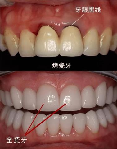 武漢仁愛(ài)口腔全瓷牙效果如何?能用多久?有什么優(yōu)勢(shì)?