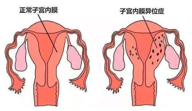 了解地諾孕素作用于異位癥的原理,針對性治療才有效