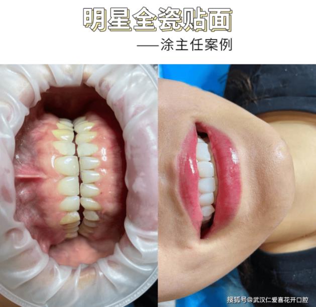 武漢仁愛口腔醫(yī)院正規(guī)嗎?網(wǎng)友好評:根管治療、牙齒美白、全瓷貼面...安心可靠!