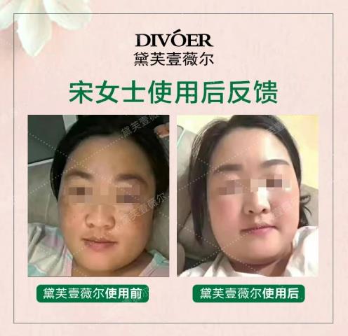 坎坷祛斑路:分享真實有效的祛斑方法——黛芙壹薇爾祛斑組合