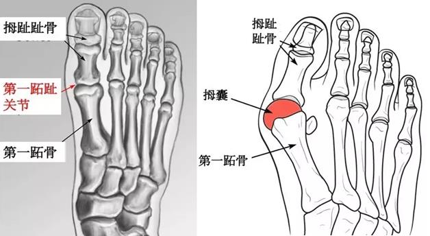 大腳骨醫(yī)生蘇敬達(dá):大腳骨的保守治療方法有效果嗎?