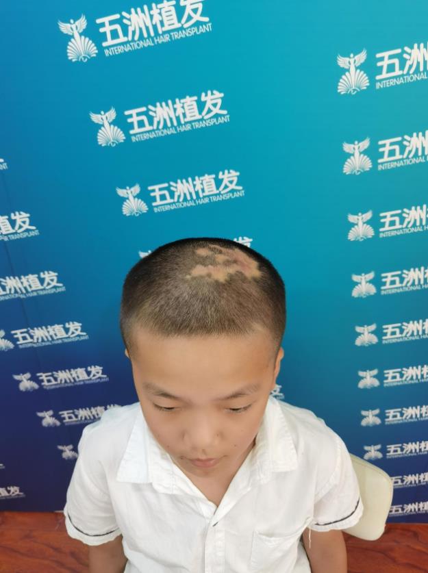 武漢五洲整形“有愛童享”公益救助11歲“禿頂男孩”:植回自信,重拾未來