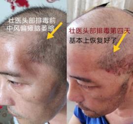 神奇的——壯醫(yī)頭部排毒