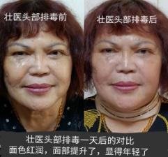 神奇的——壯醫(yī)頭部排毒