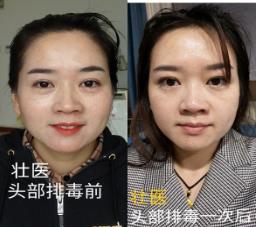 神奇的——壯醫(yī)頭部排毒