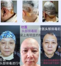 神奇的——壯醫(yī)頭部排毒