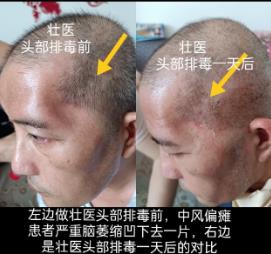 神奇的——壯醫(yī)頭部排毒