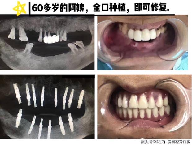 武漢仁愛(ài)口腔微創(chuàng)種植丨無(wú)痛、快捷讓你告別種植恐懼!