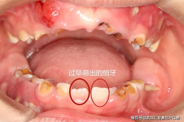 武漢仁愛口腔案例表示:“猛性齲”未及時(shí)治療,4歲男童一口牙幾乎爛光