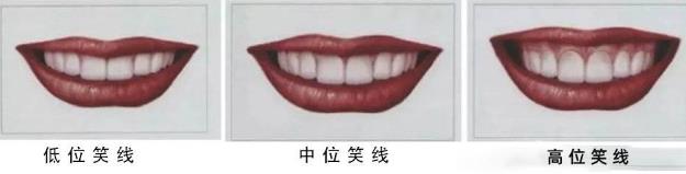 武漢仁愛(ài)口腔怎么樣?網(wǎng)友:為什么我笑的呆板顯老?牙醫(yī):牙齒矯正中不可忽視的微笑線!