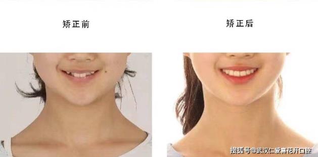 武漢仁愛(ài)口腔怎么樣?網(wǎng)友:為什么我笑的呆板顯老?牙醫(yī):牙齒矯正中不可忽視的微笑線!