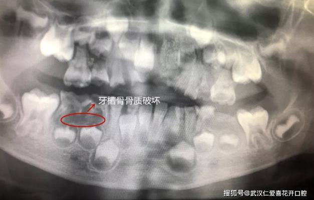 武漢仁愛口腔案例表示:“猛性齲”未及時(shí)治療,4歲男童一口牙幾乎爛光