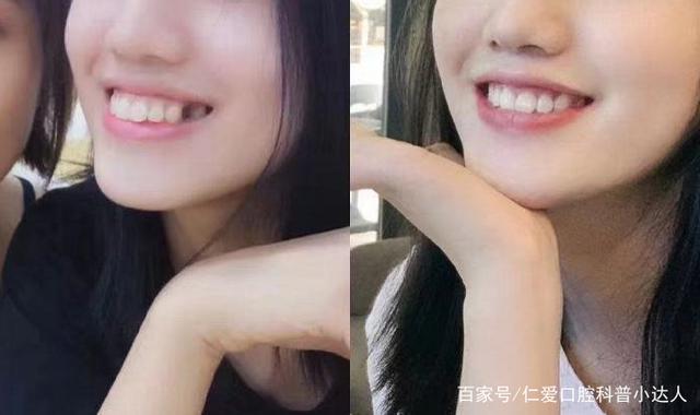 武漢仁愛口腔牙齒矯正——地包天女孩逆襲記!