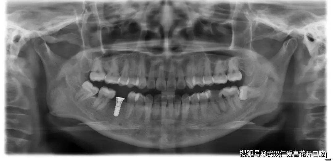 武漢仁愛口腔:種牙親身經(jīng)歷分享(歷時(shí)4個(gè)月),解決年輕人的蛀牙缺牙煩惱!