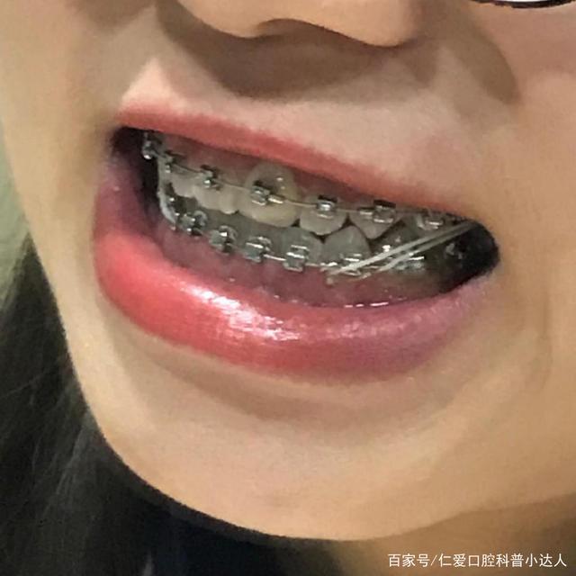 武漢仁愛口腔牙齒矯正——地包天女孩逆襲記!