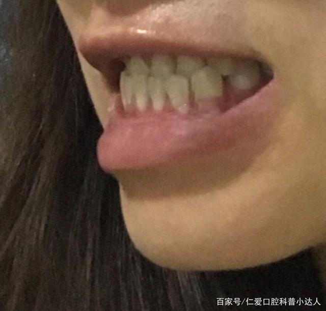 武漢仁愛口腔牙齒矯正——地包天女孩逆襲記!
