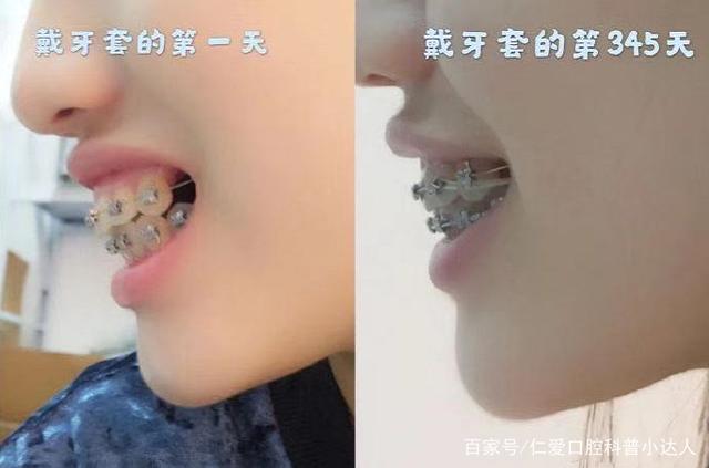 武漢仁愛口腔牙齒矯正——地包天女孩逆襲記!