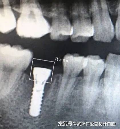 武漢仁愛口腔:種牙親身經(jīng)歷分享(歷時(shí)4個(gè)月),解決年輕人的蛀牙缺牙煩惱!