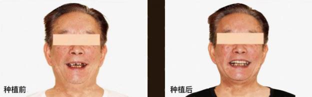 武漢仁愛口腔:半口即刻種植2小時,當(dāng)天種當(dāng)天用!