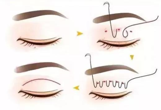 北京蘇亞醫(yī)美解答:第二次做雙眼皮屬于修復(fù)嗎?