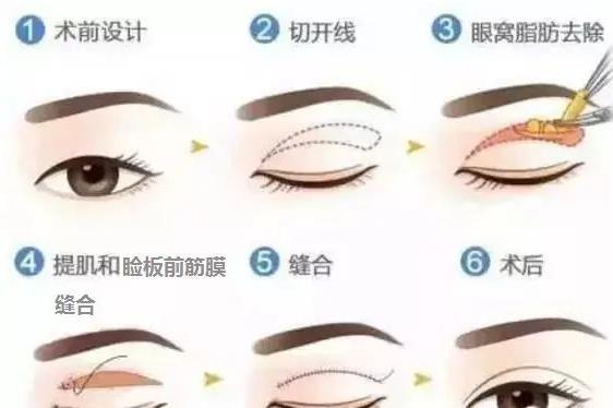 北京蘇亞醫(yī)美解答:第二次做雙眼皮屬于修復(fù)嗎?