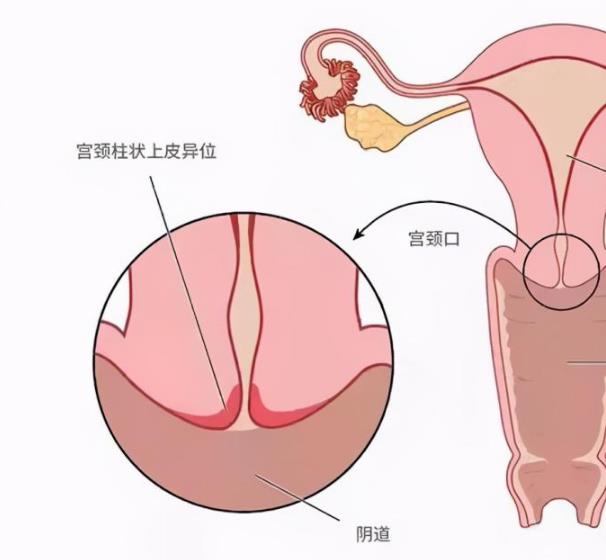 武漢仁愛醫(yī)院婦科:宮頸疾病,女人的紅顏禍“水”!!