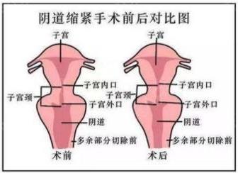 重慶軍科私密整形醫(yī)院——什么是陰道緊縮術?