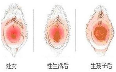 重慶軍科私密整形醫(yī)院——什么是陰道緊縮術?