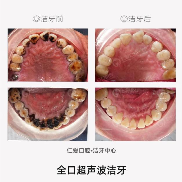 “920全國愛牙日”喜花開買單,請(qǐng)你在仁愛口腔免費(fèi)洗牙