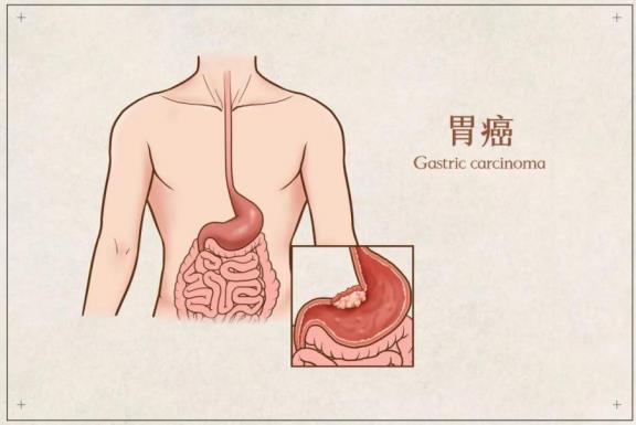 呼市東大肛腸醫(yī)院 這3個情況伴隨胃癌高危信號