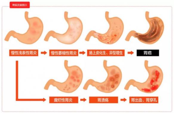 呼市東大肛腸醫(yī)院 這3個情況伴隨胃癌高危信號