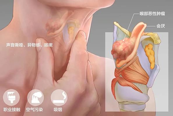 成都民生耳鼻喉醫(yī)院 多年聲嘶,喝酒抽煙又熬夜是怎么回事