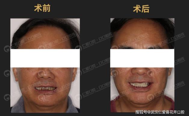 武漢仁愛口腔:70歲王大爺缺牙十多年一直不敢種牙,“數(shù)字化即刻負(fù)重”讓他一天內(nèi)重享口福!