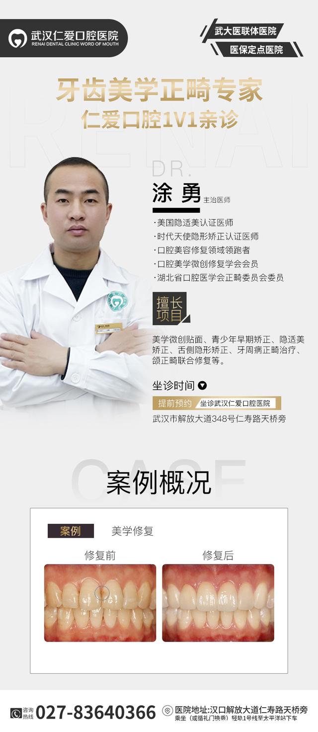武漢仁愛口腔案例 ▏ 義獲嘉瓷貼面 搭配微笑曲線設(shè)計,展現(xiàn)專屬微笑