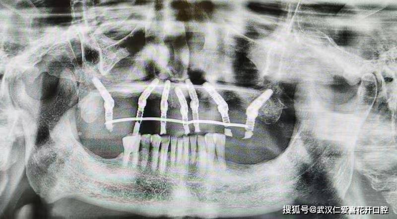 種植案例:80歲吳大爺“活動(dòng)假牙換種植牙”吃得好、嚼得爛、精神好!