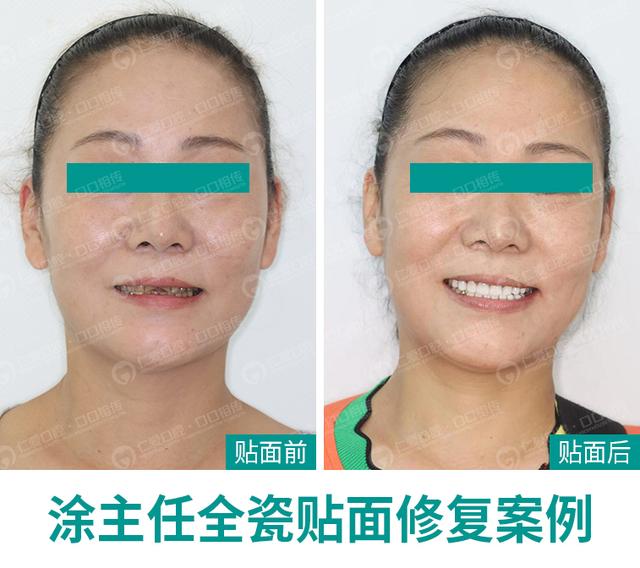 武漢仁愛口腔案例 ▏ 義獲嘉瓷貼面 搭配微笑曲線設(shè)計,展現(xiàn)專屬微笑