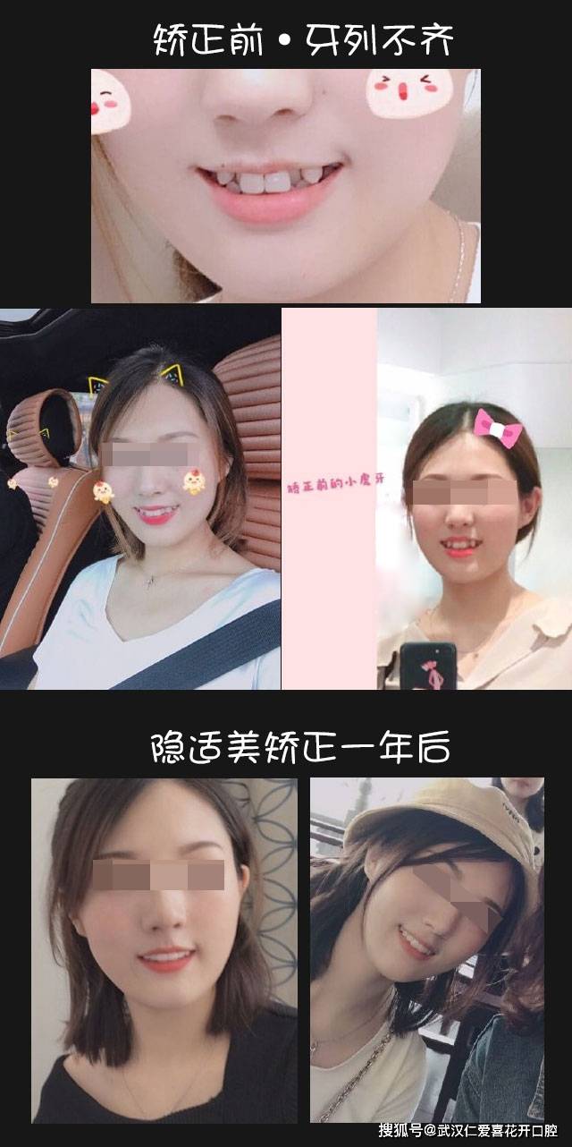 武漢仁愛口腔#牙齒矯正案例來自30歲美女的整牙日記
