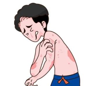 重慶哪家醫(yī)院治療牛皮癬?牛皮癬可以這樣做