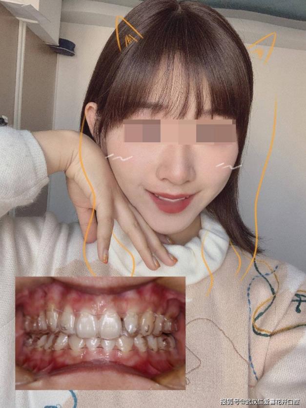 武漢仁愛口腔 ▏00后小姐姐整牙逆襲記!