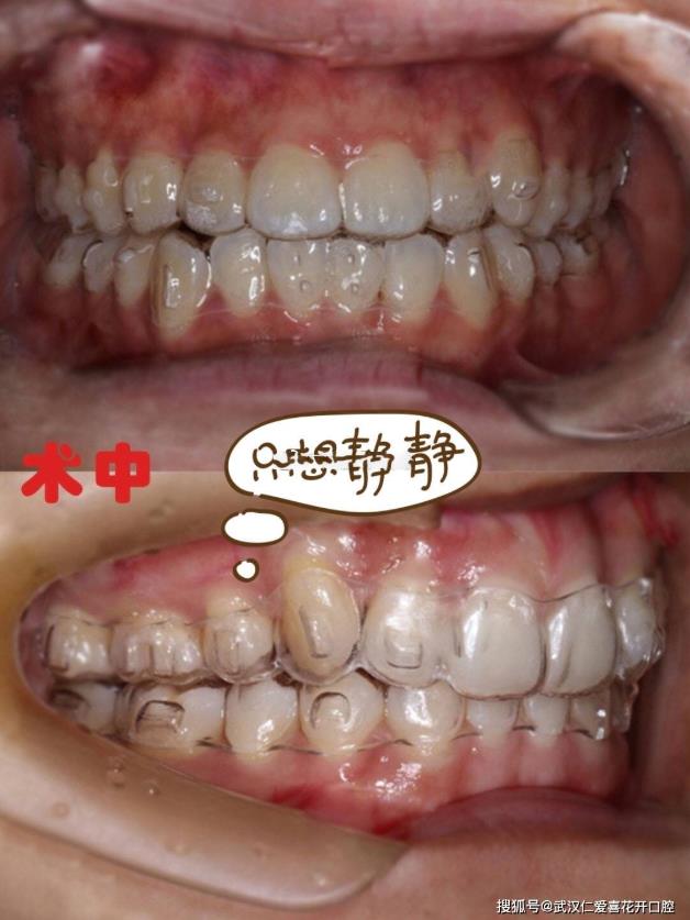 武漢仁愛口腔 ▏00后小姐姐整牙逆襲記!